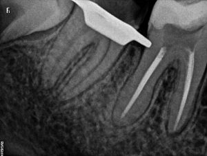 dentaline-rentgeno-foto